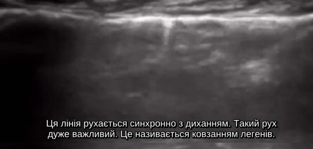 A shot from a movie with Ukranian subtitles: "Ця лінія рухається синхронно з диханням. Такий рух дуже важливий. Це називається ковзанням легенів."

English Translation: "This line moves in sync with breathing. Such movement is very important. It is called lung sliding."